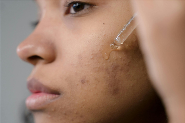 How do skincare products help in reducing redness and irritation?